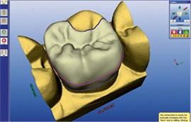 Advanced Dentistry - Sirona Crown CAD/CAM Sirona Crown Machine